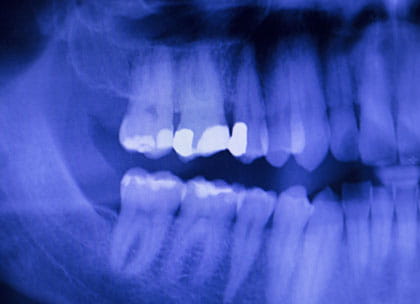 X-ray of fillings